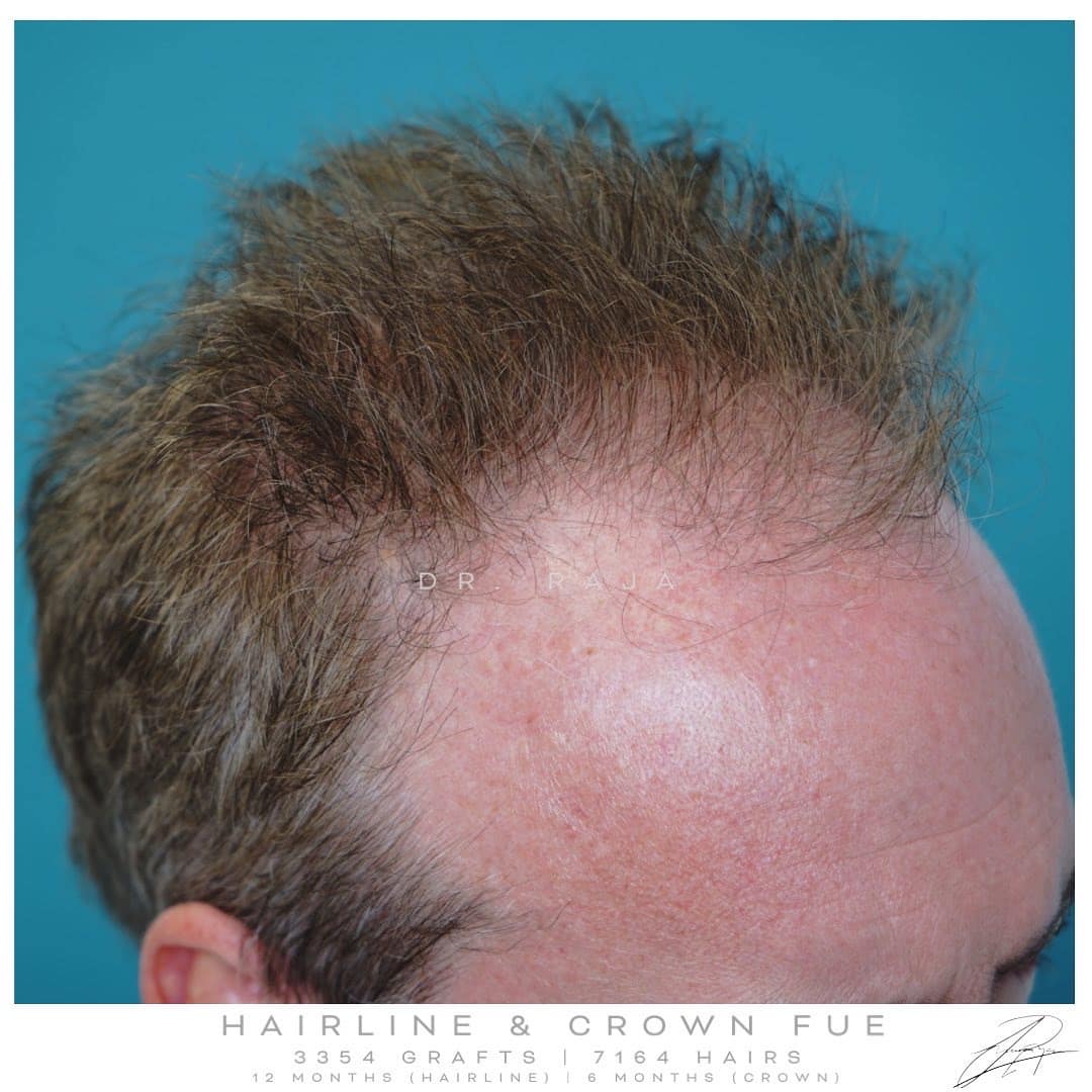 hairline FUE Raja