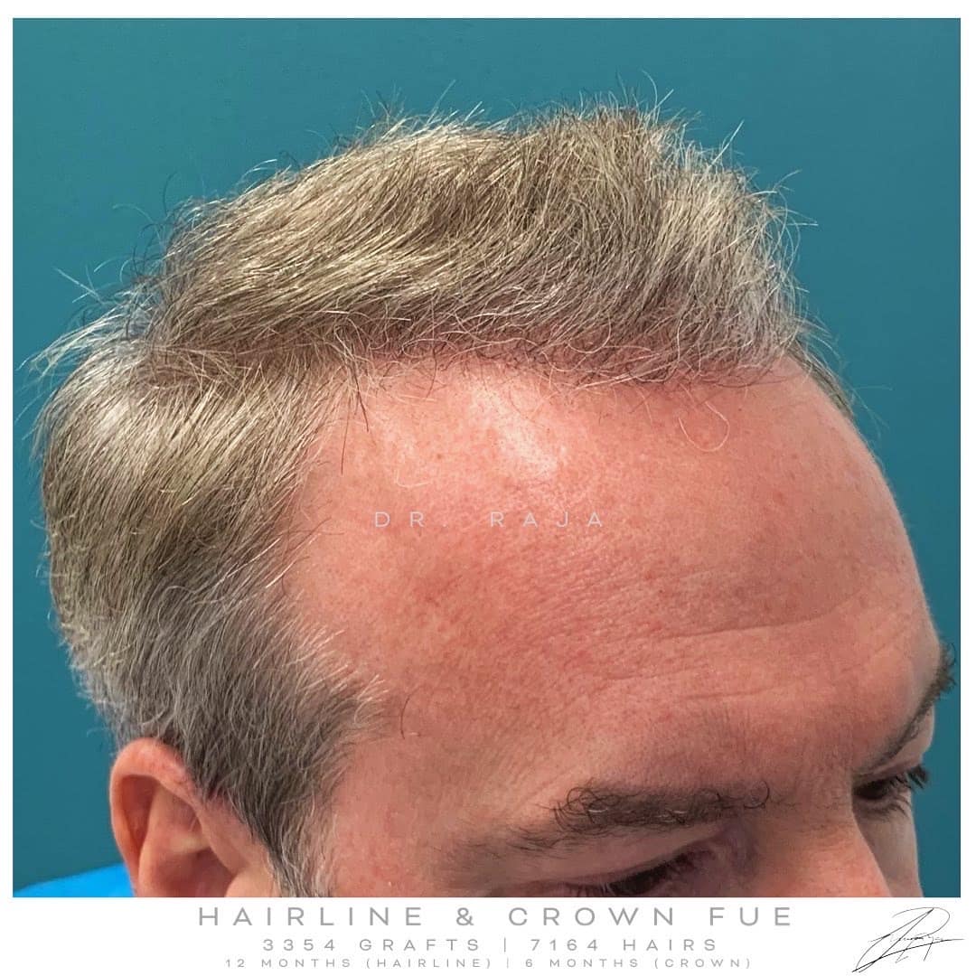 Hairline FUE After