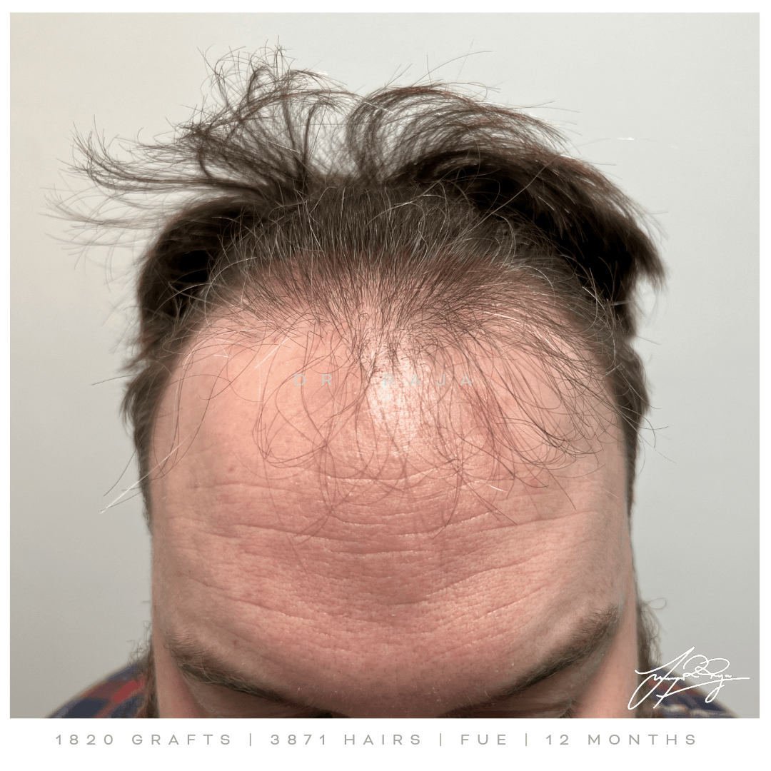 Dr. Raja reviews hair transplant results