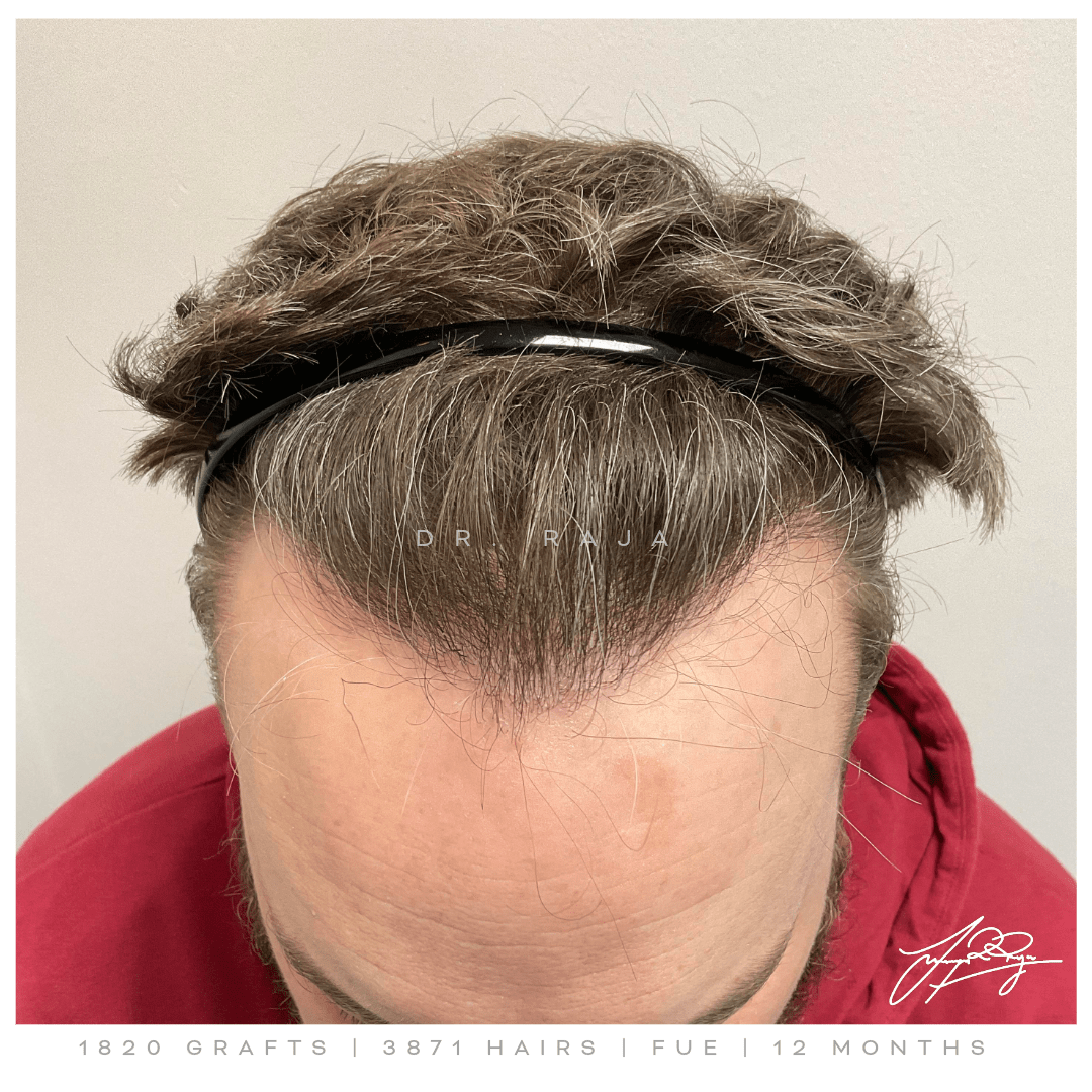 Dr. Raja reviews hair transplant results