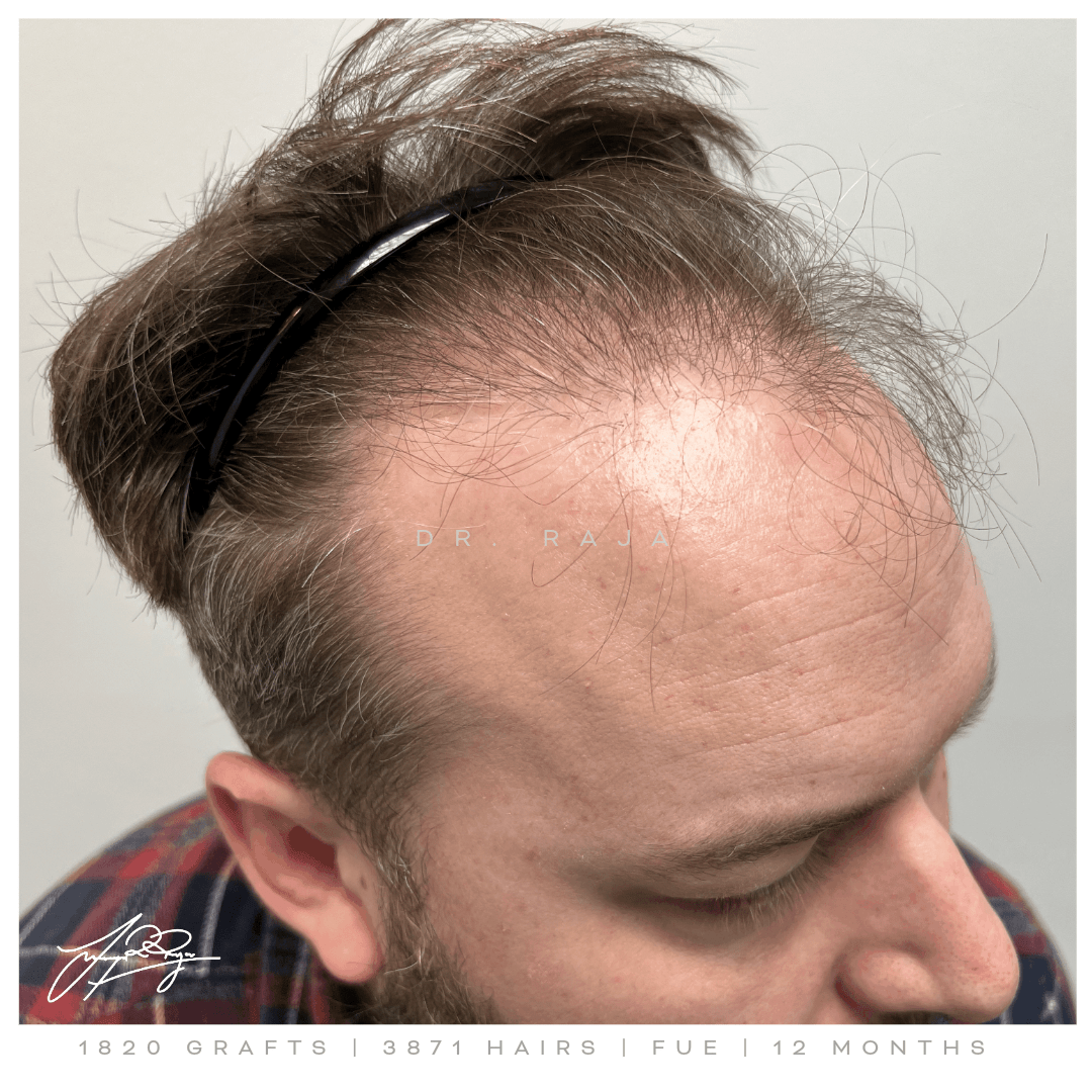 Dr. Raja hair transplant reviews before after