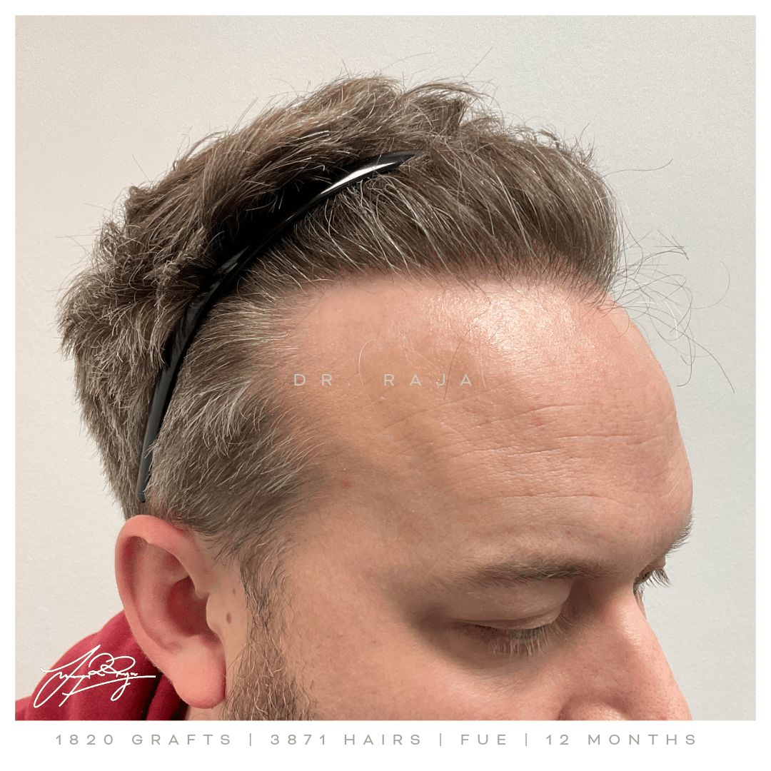 Dr. Raja hair transplant reviews before after