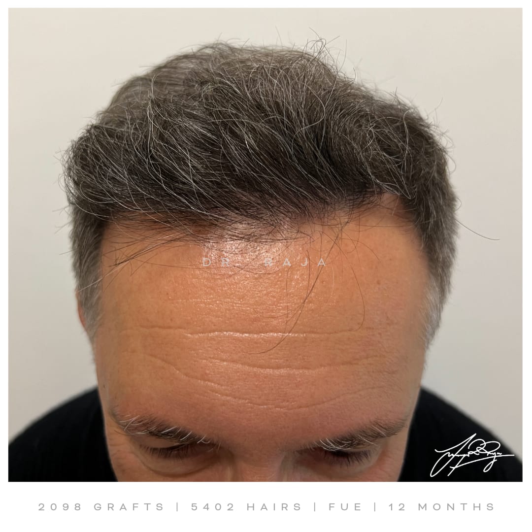 Dr. Raja after hair transplant