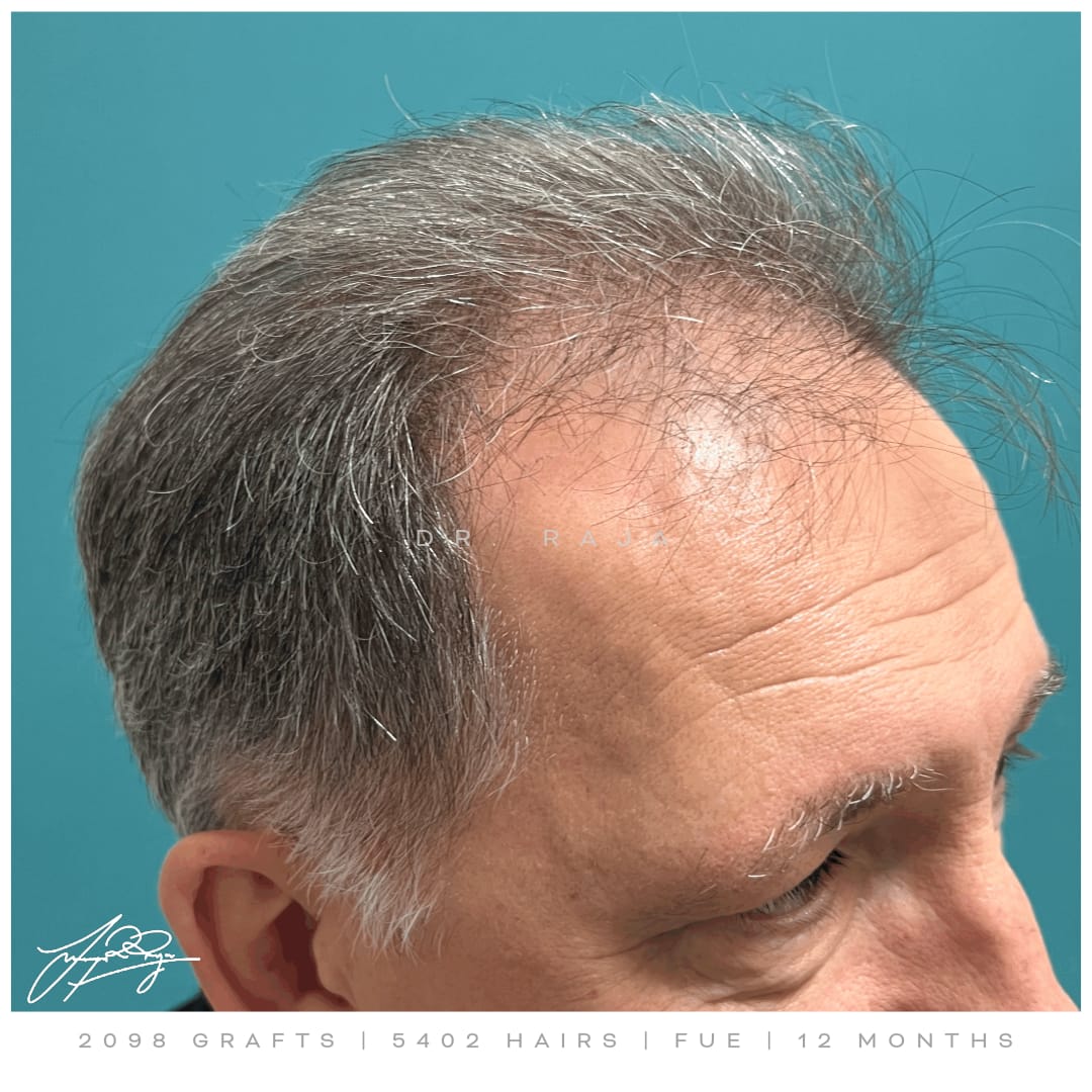 Dr. Raja hair transplant results