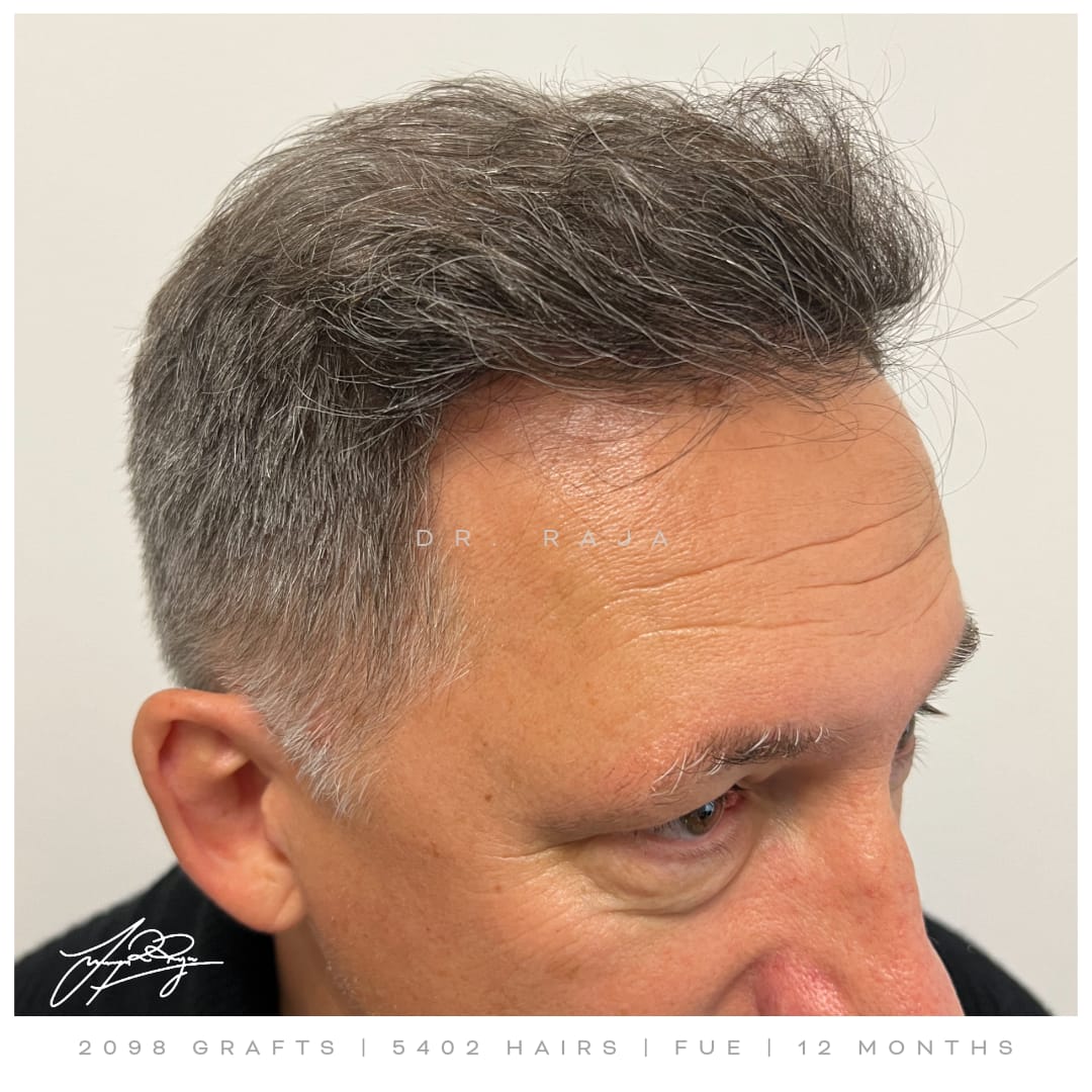 Dr. Raja hair transplant results after