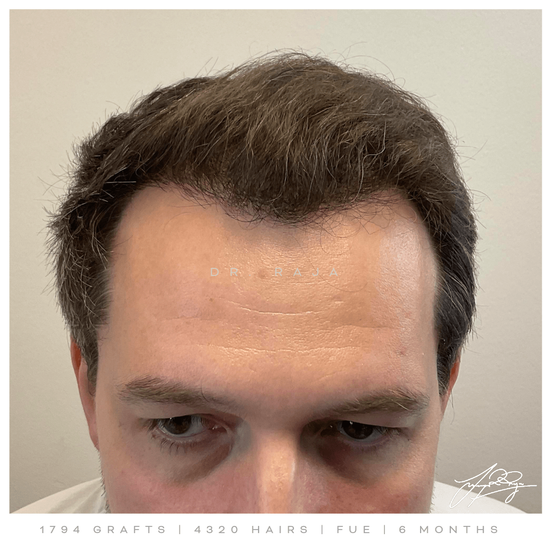 Dr. Raja reviews hair transplant results