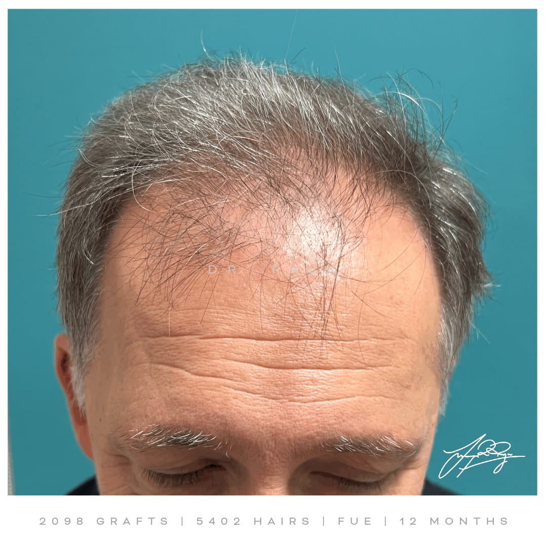 Dr. Raja hair transplant before & after