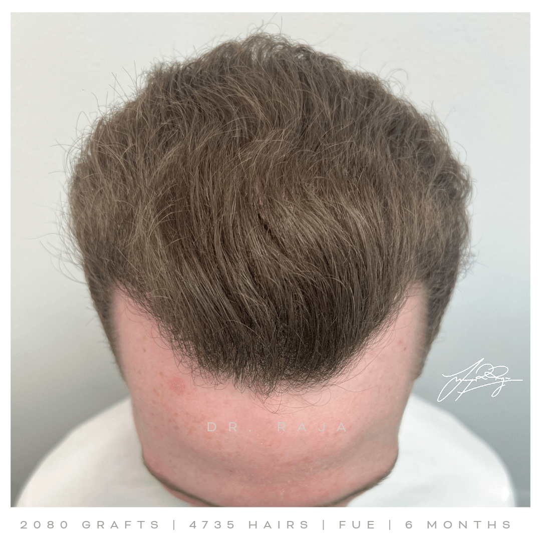 Dr. Raja FUE After result