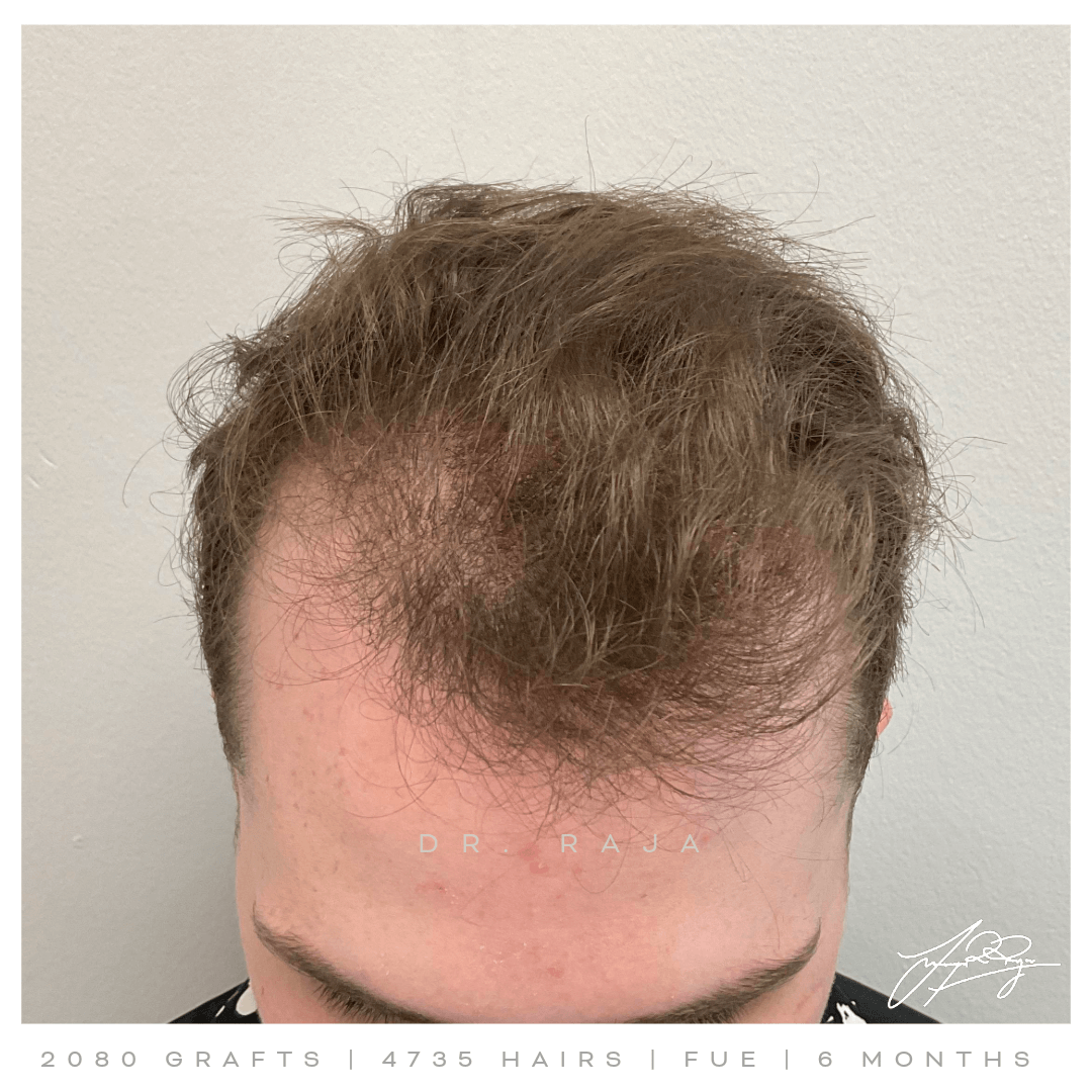 Dr. Raja FUE Before
