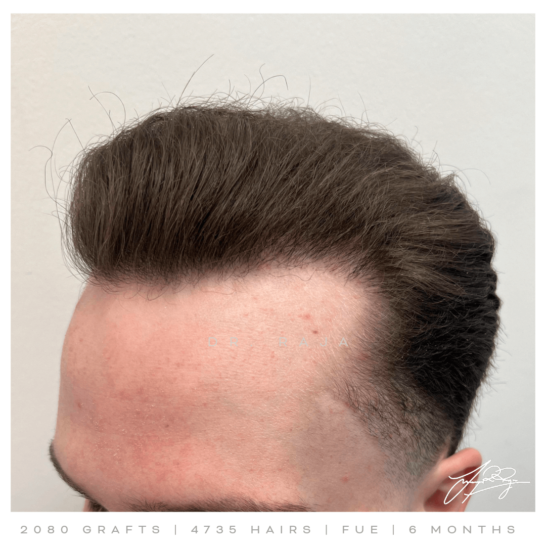 Dr. Raja FUE After Result