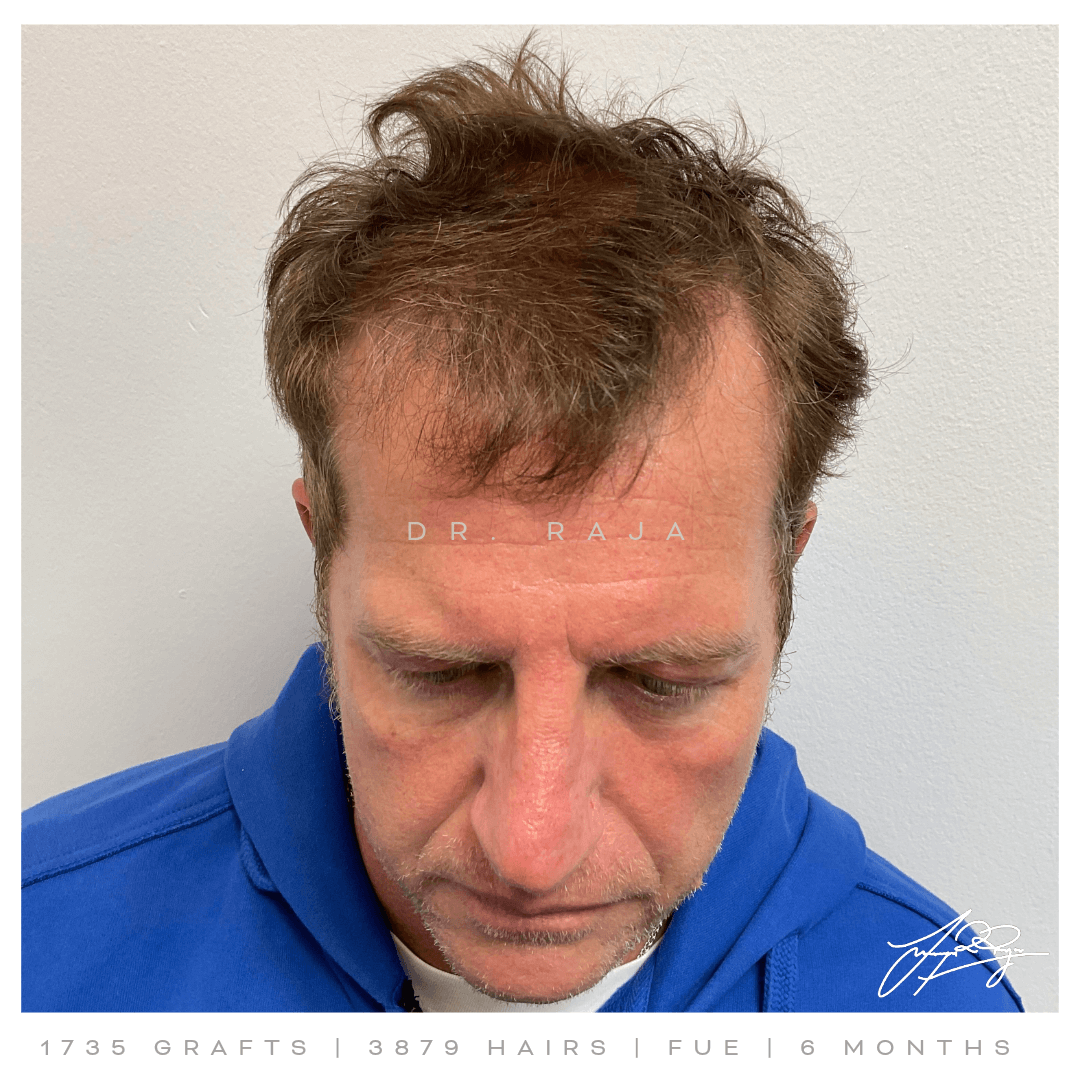 Dr. Raja FUE before after