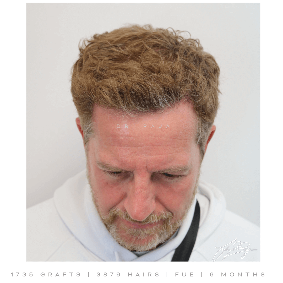 Dr. Raja FUE Result