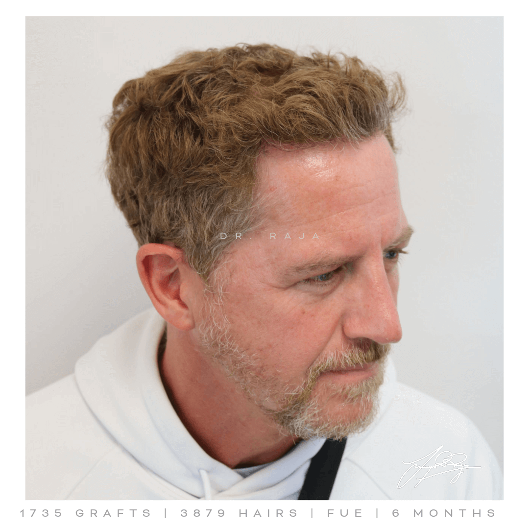 Dr. Raja FUE After