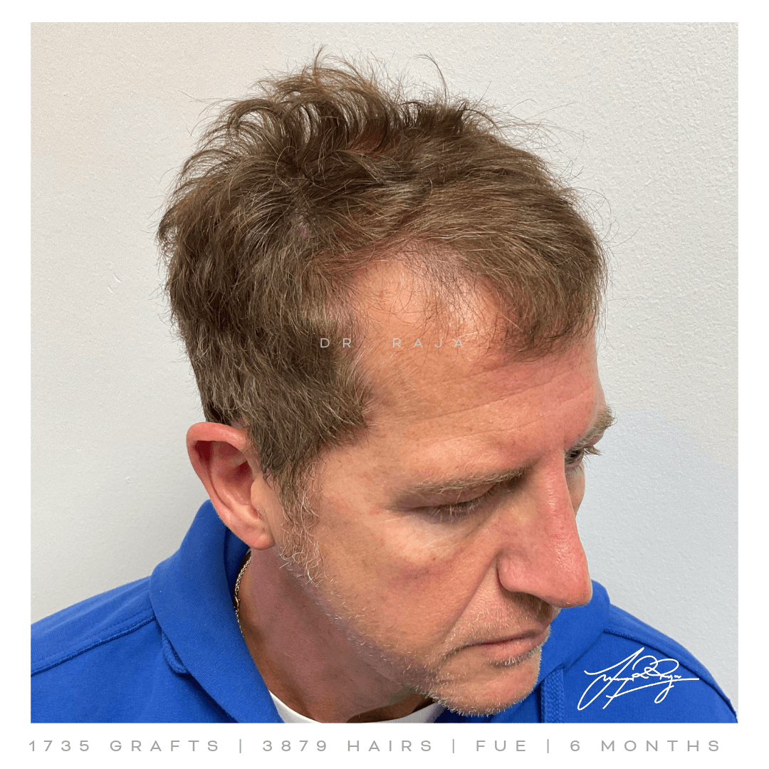 Dr. Raja FUE Before
