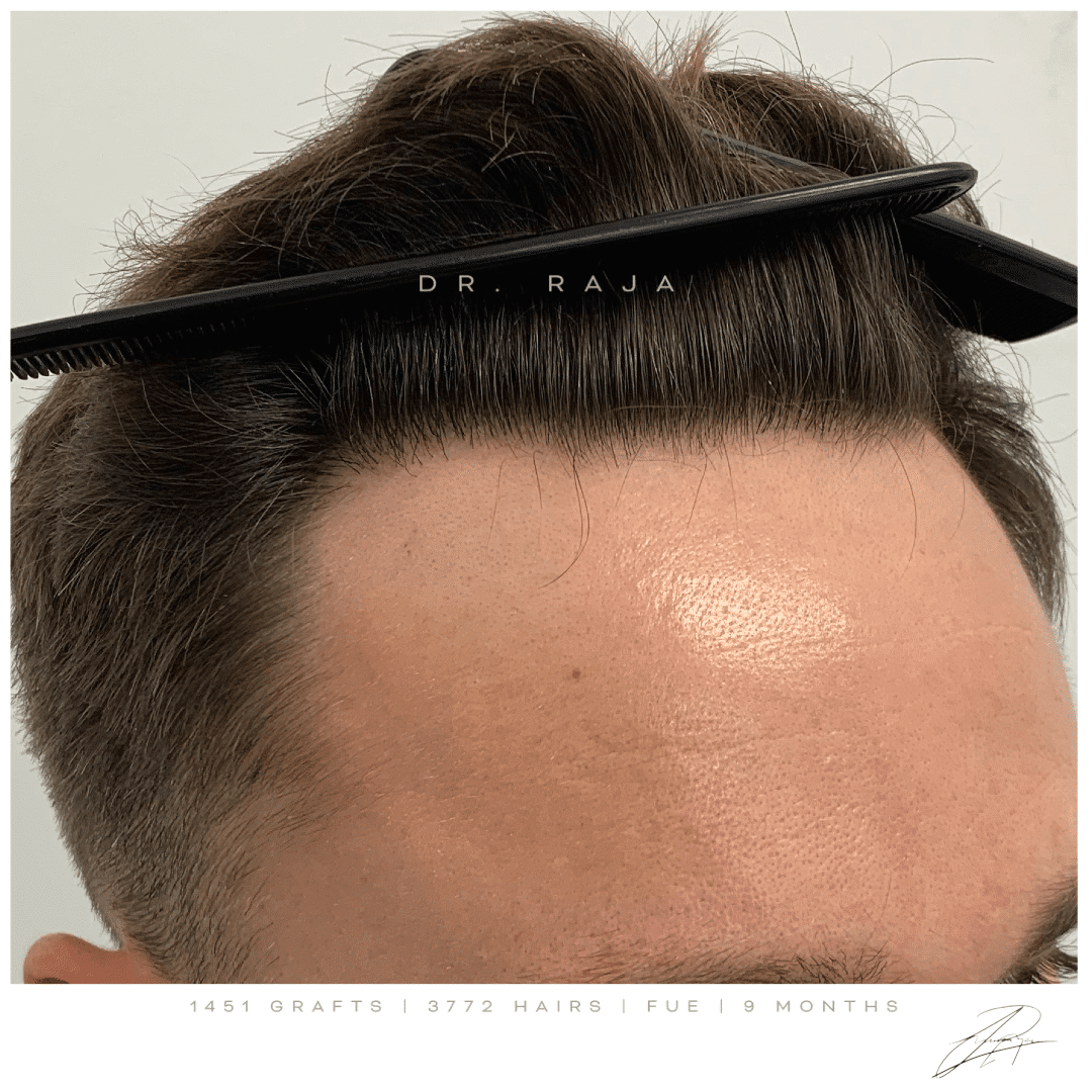 Dr. Raja FUE After