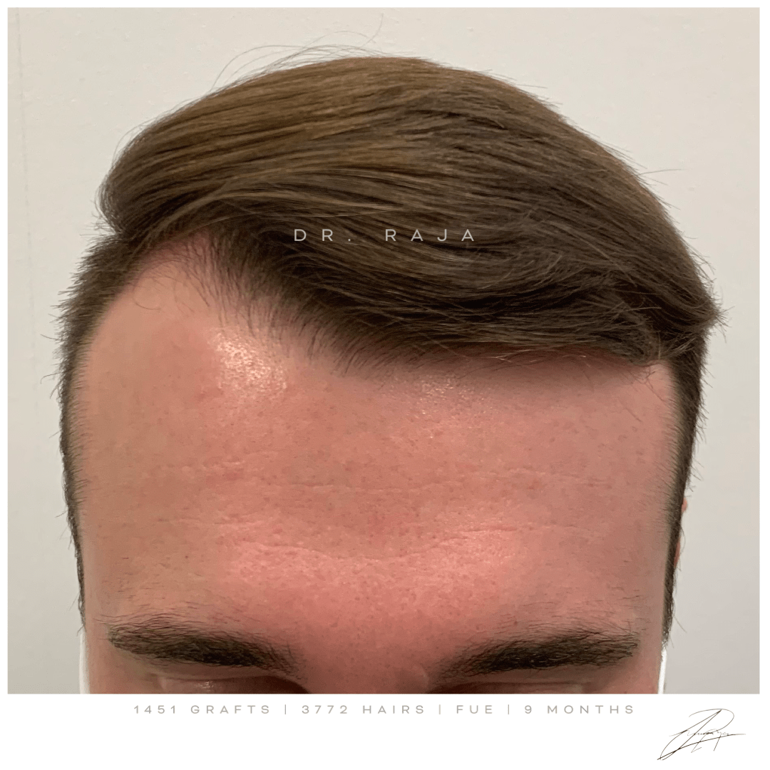 dr raja FUE before