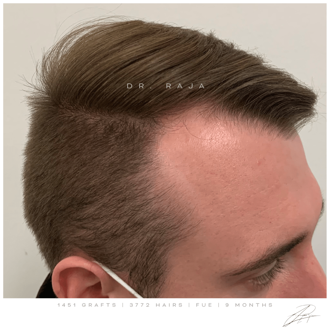 dr raja FUE before