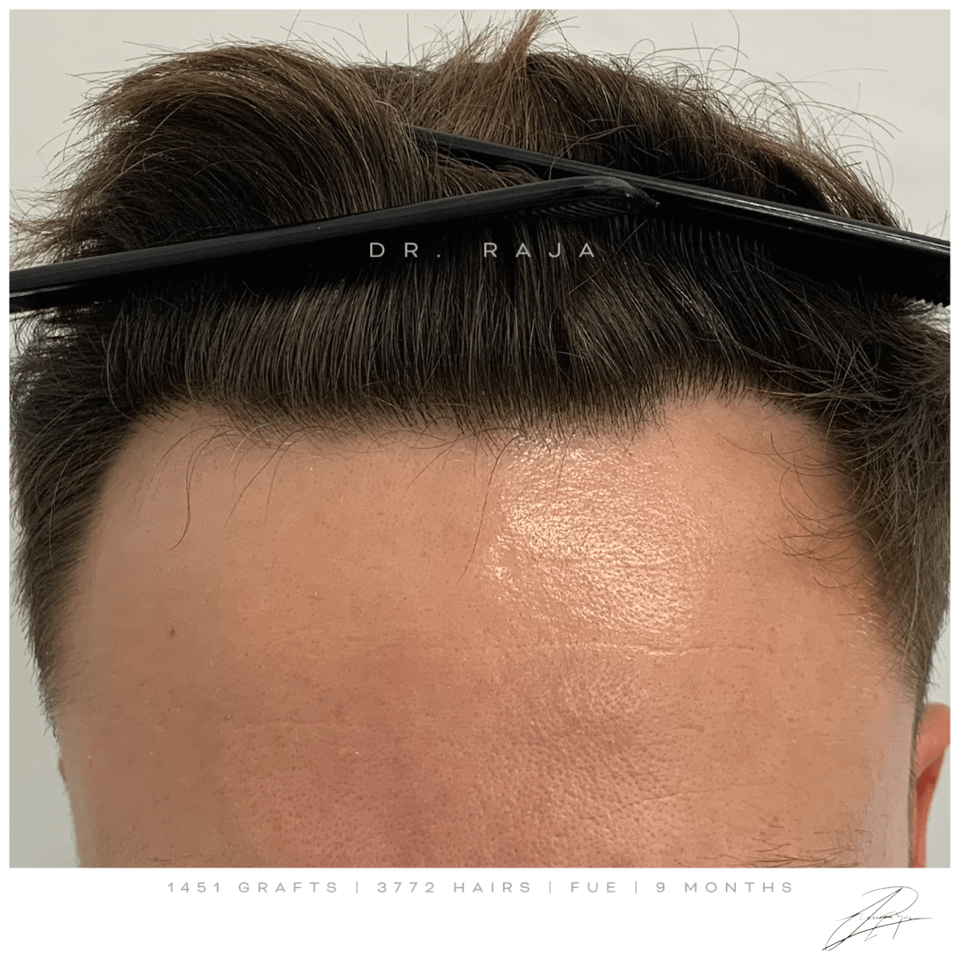 Dr. Raja FUE After