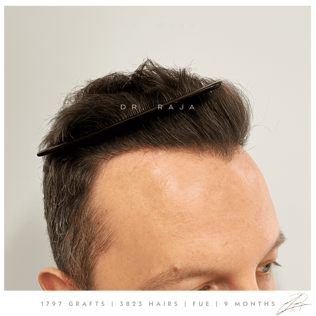 Dr. Raja FUE After