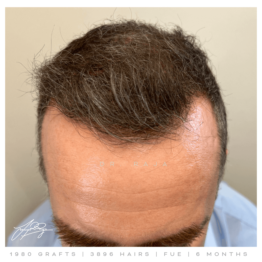 Dr. Raja FUE After