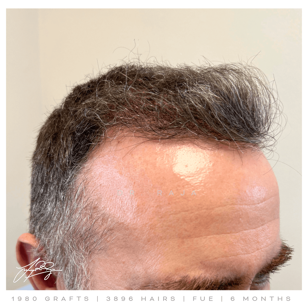 Dr. Raja FUE After