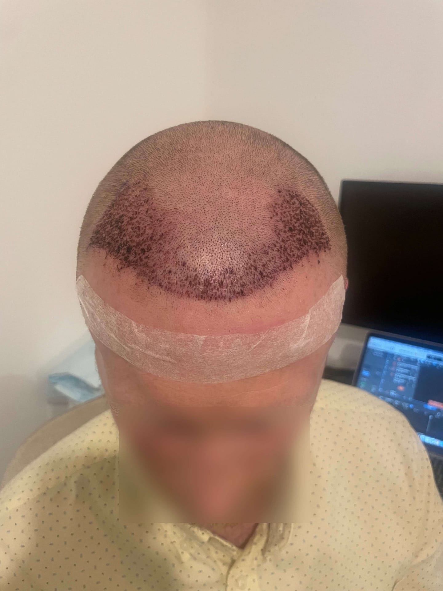 FUE Hair Transplant post-op