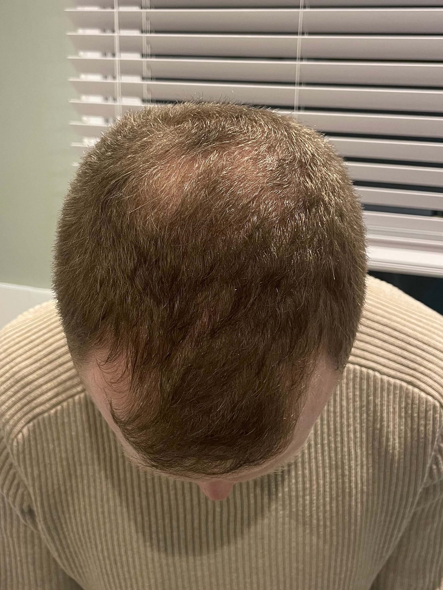 FUE Hair transplant stabilisation
