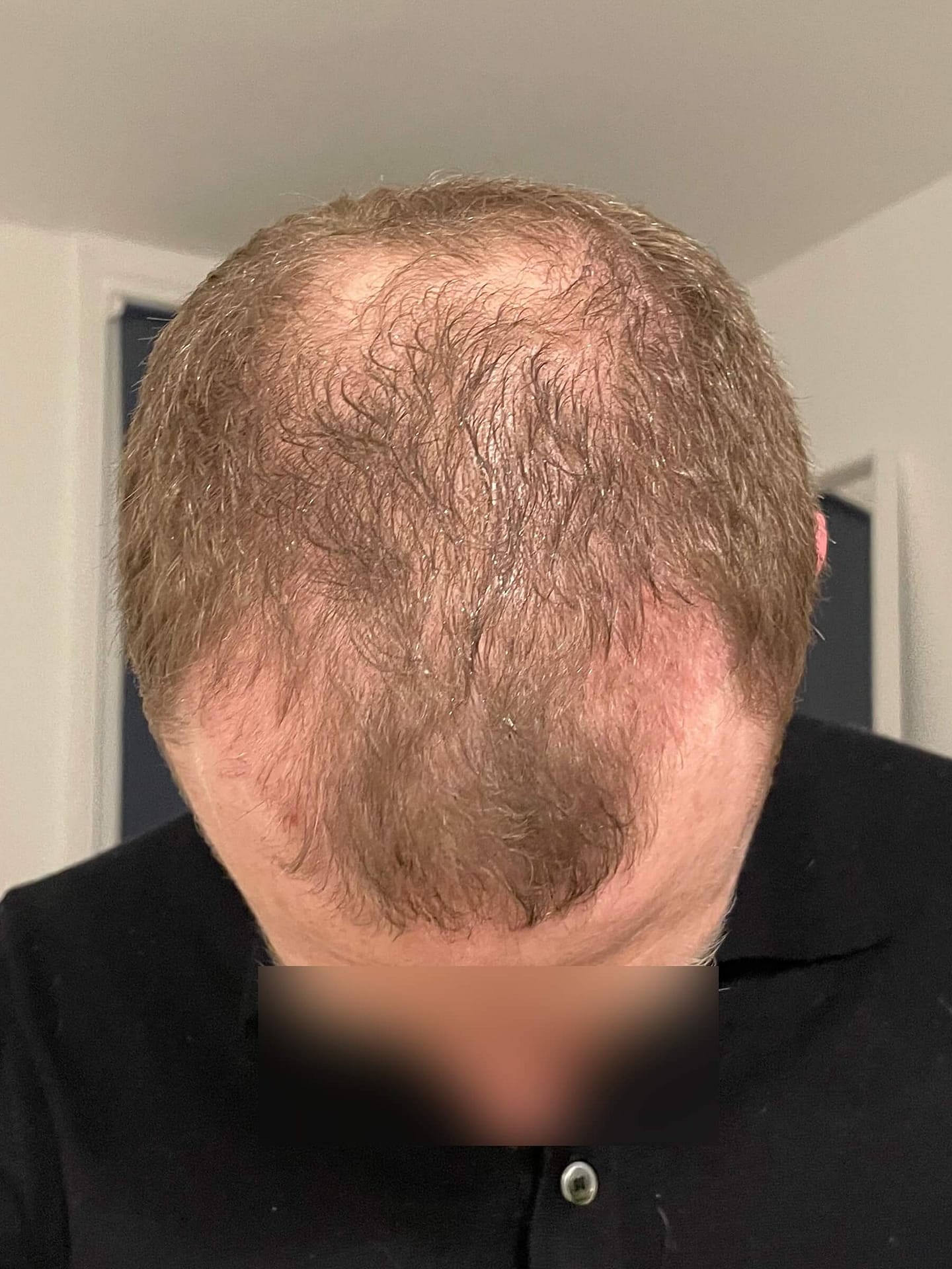 Shedding FUE hair transplant 