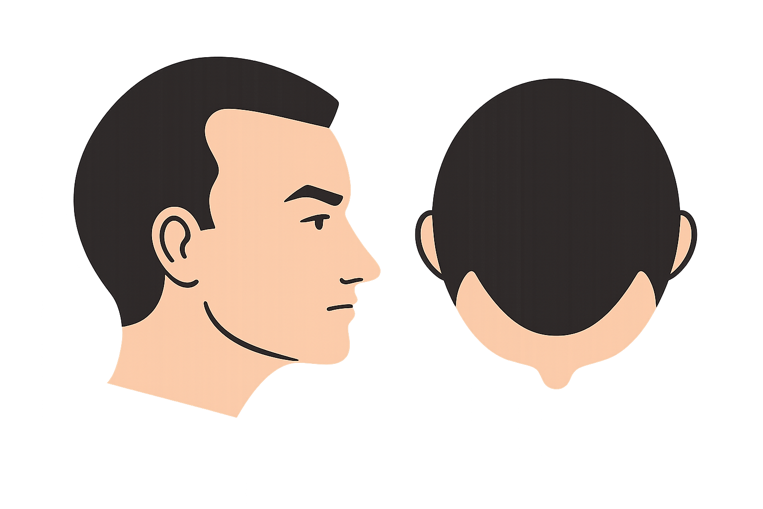 FUE Hair Transplant small